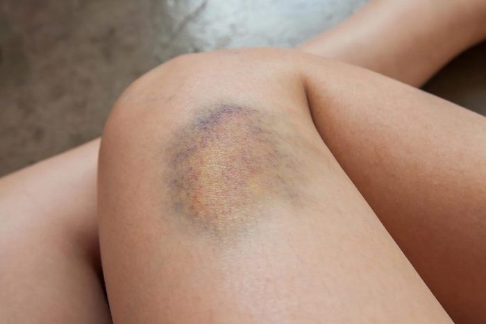 Vỡ Vein Là Gì? Gallery 1
