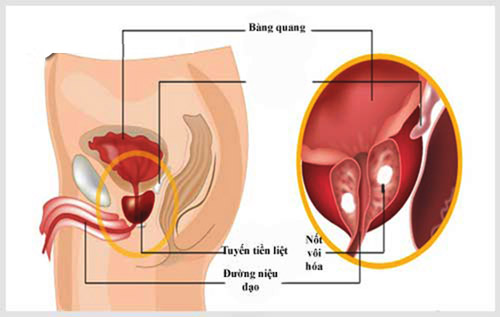 Vôi hóa tuyến tiền liệt là gì? Gallery 1