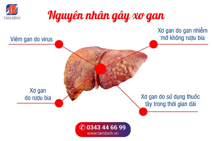 Xơ xuất là gì? Nguyên nhân, triệu chứng và cách điều trị Gallery 1