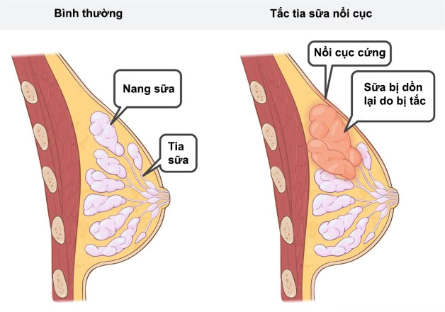 Cặn sữa là gì? Gallery 1