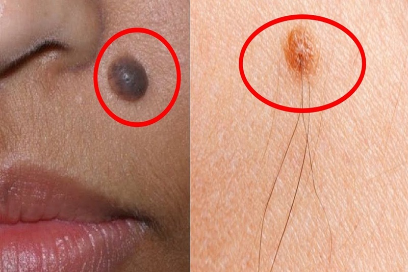 Mụn Ruồi Từ Đâu Mà Có? Gallery 1