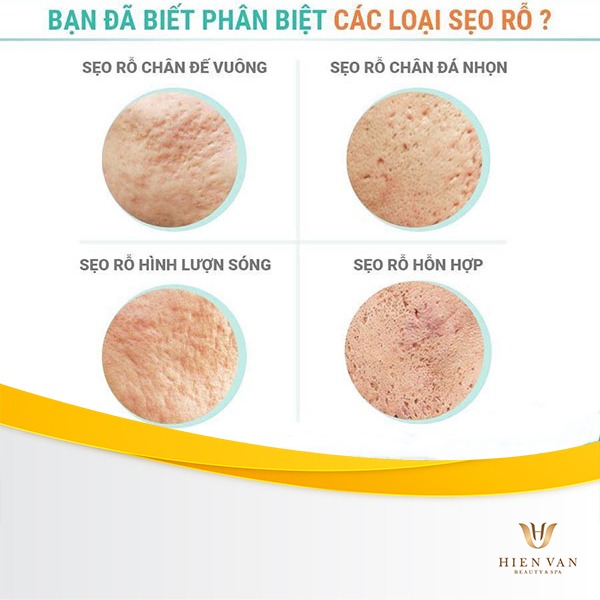 Sẹo lõm mới hình thành: Nguyên nhân, cách điều trị và phòng ngừa Gallery 1