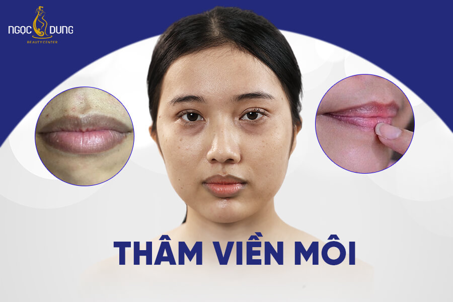 Trẻ bị thâm viền môi: Nguyên nhân và cách khắc phục Gallery 1