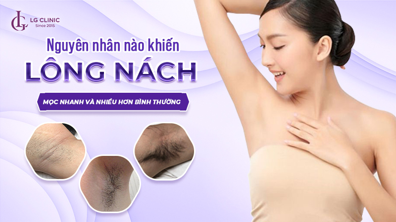 Lông nách mọc nhanh và nhiều: Nguyên nhân và cách khắc phục Gallery 1