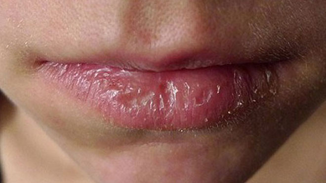 Môi bị nhiễm chì: Nguyên nhân, triệu chứng và cách điều trị Gallery 1