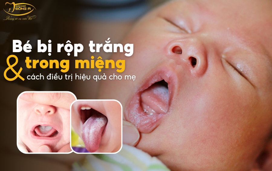 Môi Trẻ 2 Tuổi Bị Rộp Trắng: Nguyên Nhân và Cách Điều Trị Gallery 1