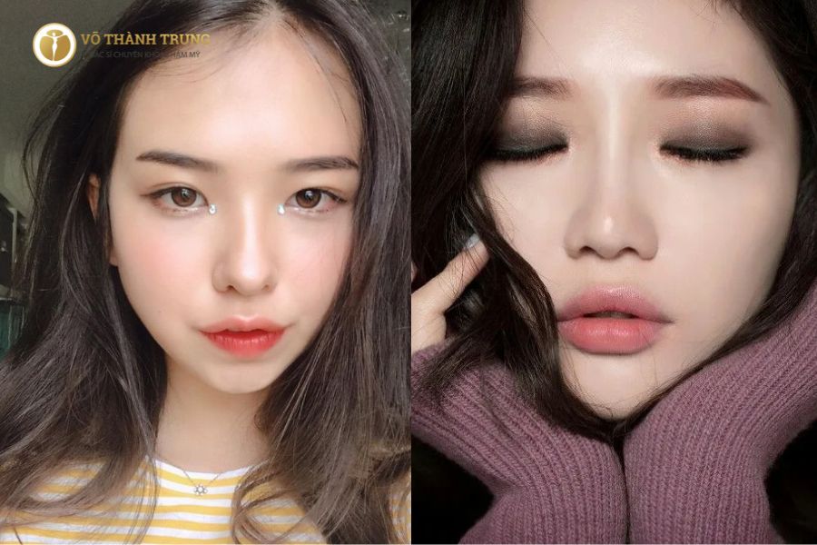 Môi Trên Vểnh Lên: Nguyên Nhân, Cách Khắc Phục và Làm Đẹp Gallery 1