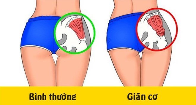 Ngồi nhiều mông bị lõm: Nguyên nhân và cách khắc phục Gallery 1