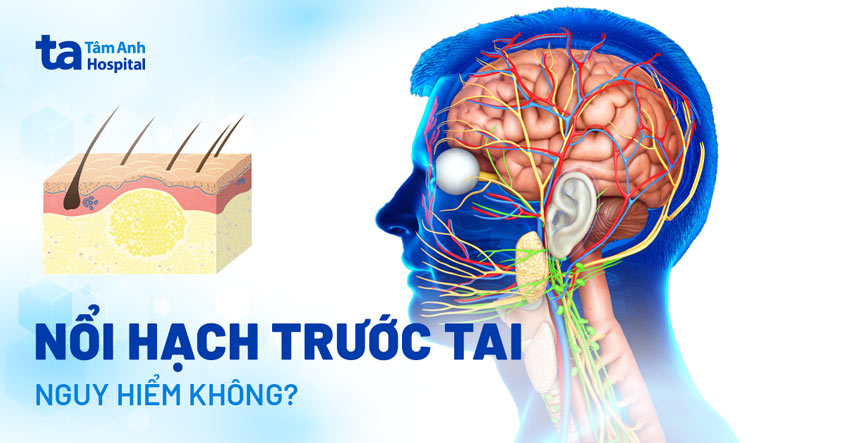 Nổi hạch ở má gần tai phải: Nguyên nhân và cách xử trí Gallery 1