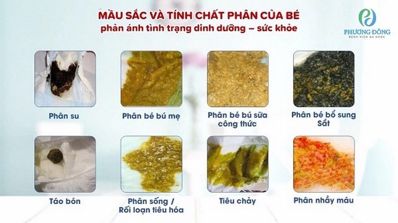 Phân Lỏng Màu Vàng: Nguyên Nhân và Cách Xử Lý Gallery 1
