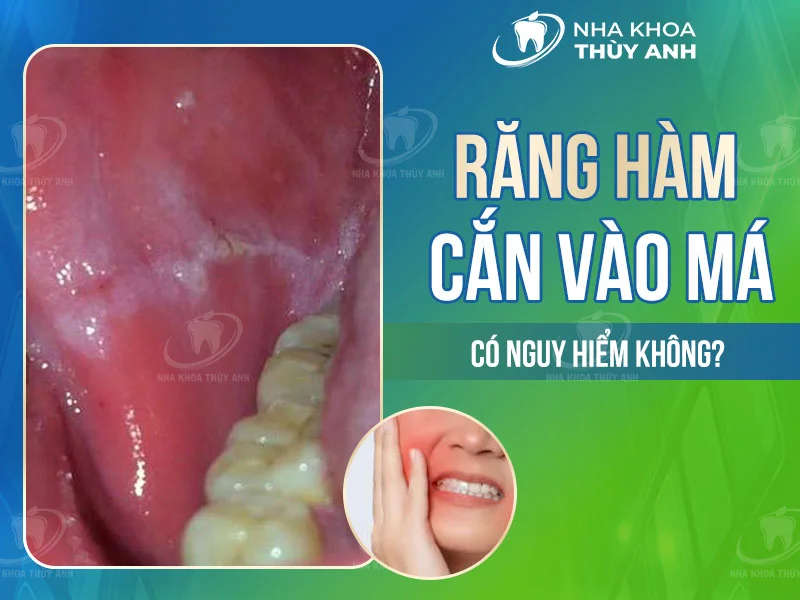 Răng cắn vào má trong: Nguyên nhân và cách khắc phục Gallery 1
