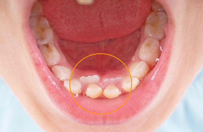 Răng Chưa Rụng Răng Mới Đã Mọc: Nguyên Nhân, Biện Pháp Khắc Phục và Khi Nào Cần Đi Khám Nha Khoa Gallery 1