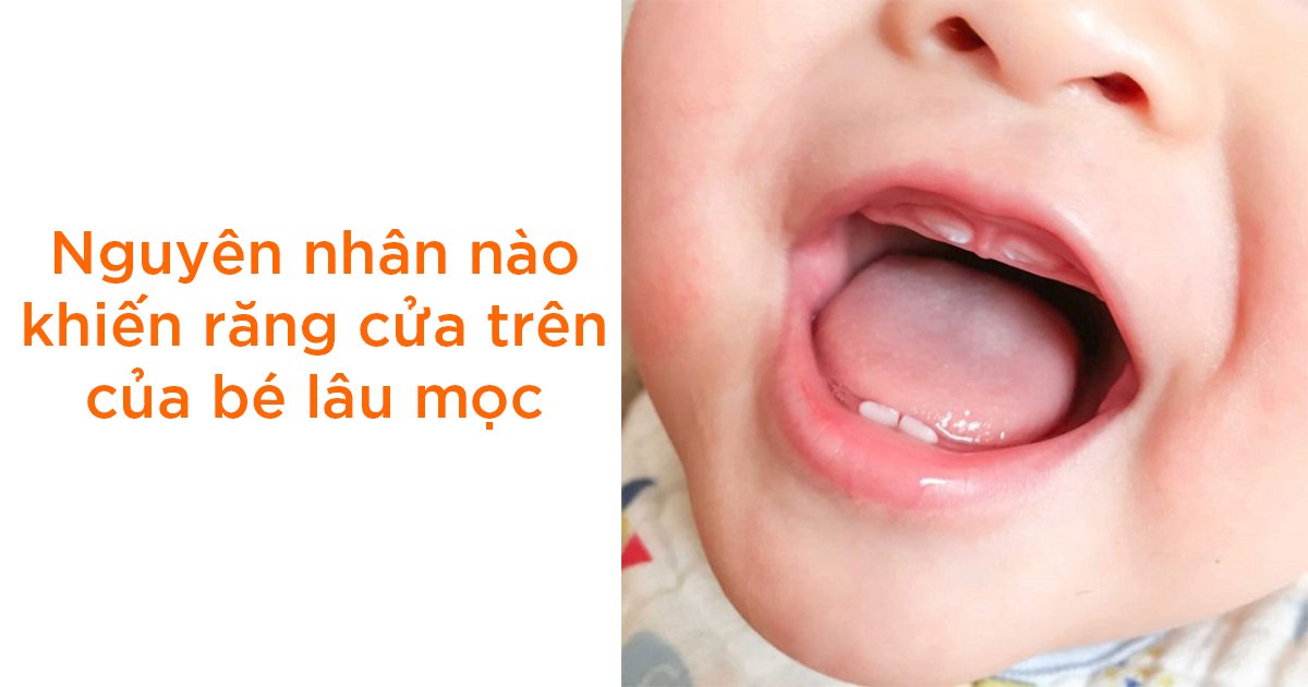 Răng cửa trên lâu mọc: Nguyên nhân và cách xử lý Gallery 1