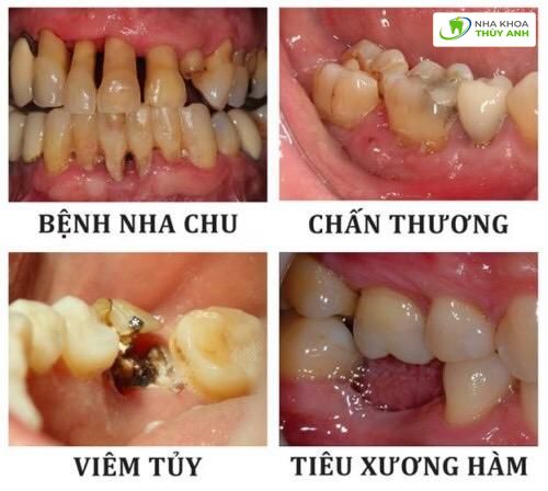Răng số 6 bị lung lay đau nhức: Nguyên nhân, điều trị và phòng ngừa Gallery 1