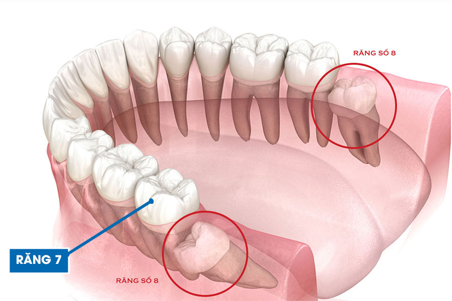 Răng số 7 bị lung lay sau khi nhổ răng số 8 Gallery 1