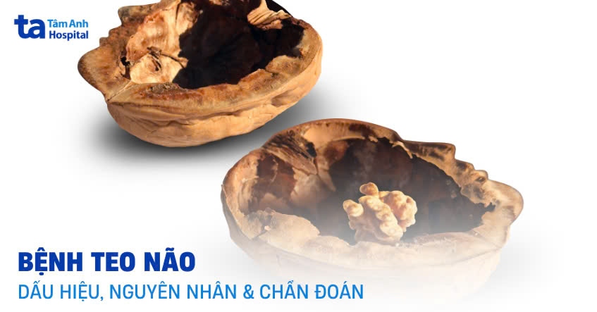 Nguyên nhân teo não