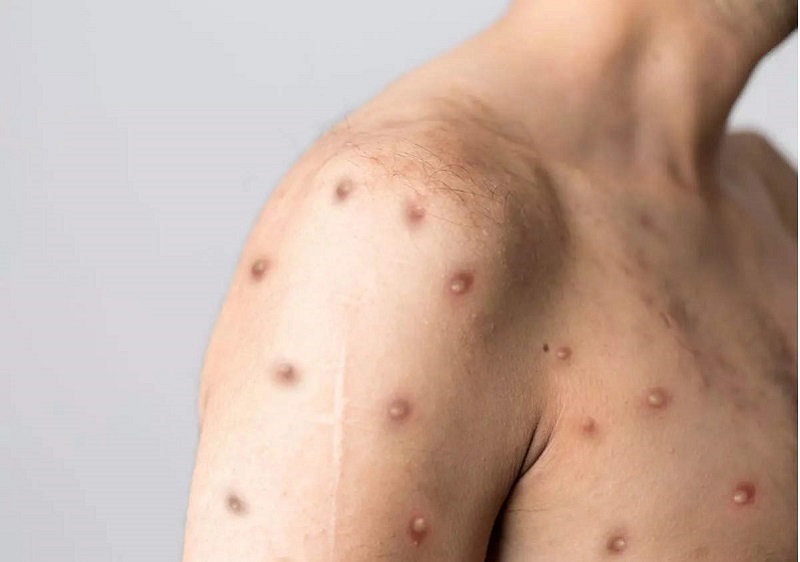 Nguyên nhân gây bệnh thủy đậu là gì?