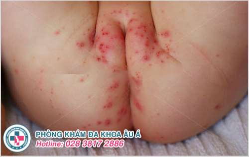 Thủy đậu mọc ở vùng kín: Nguyên nhân, triệu chứng và cách điều trị Gallery 1