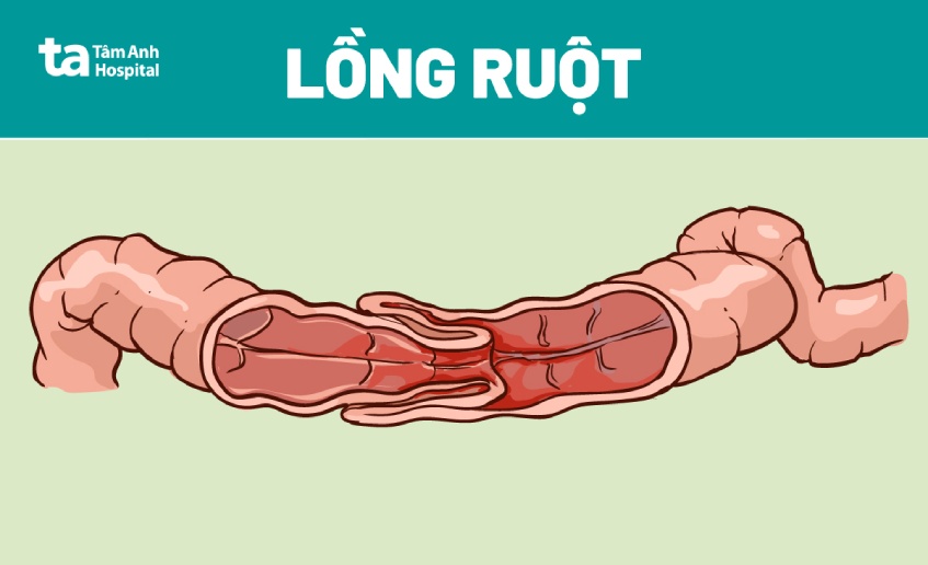 Nguyên Nhân Trẻ Bị Lồng Ruột