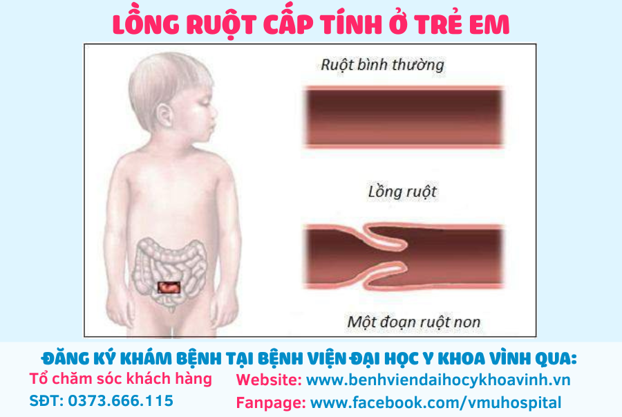 Nguyên Nhân Trẻ Bị Lồng Ruột Gallery 2