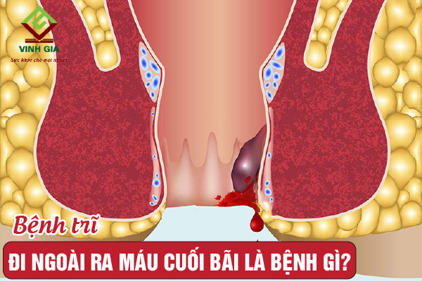 Trẻ Đi Ngoài Ra Máu Tươi Cuối Bãi: Nguyên Nhân và Cách Xử Trí Gallery 1