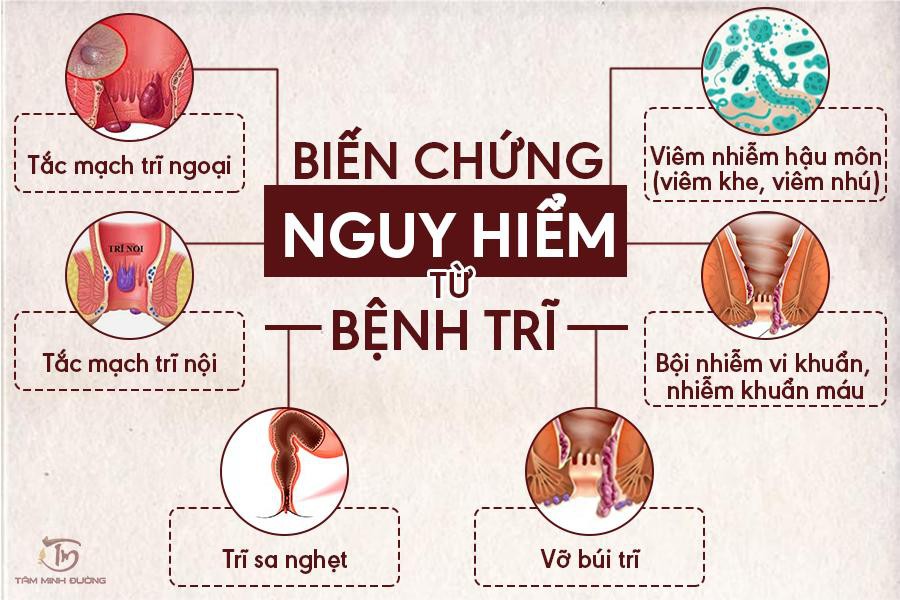 Cách Trị Bọ Trĩ Hiệu Quả Gallery 1