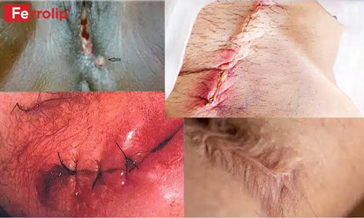 Vết Khâu Tầng Sinh Môn Bị Đứt Chỉ: Nguyên Nhân, Biện Pháp Khắc Phục và Phòng Ngừa Gallery 1