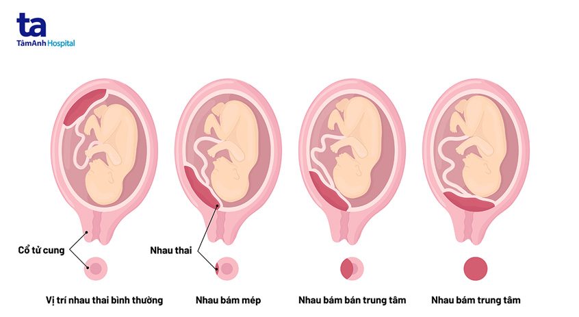 Nhau Bám Đáy Tử Cung