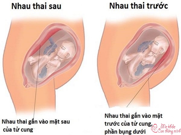 Nhau thai bám mặt sau là con trai: Sự thật hay chỉ là lời đồn?