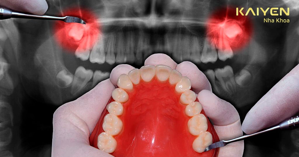 Nhổ 2 răng hàm cùng lúc: Điều cần biết
