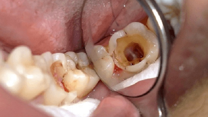 Nhổ răng hàm dưới bị sâu có nguy hiểm không?
