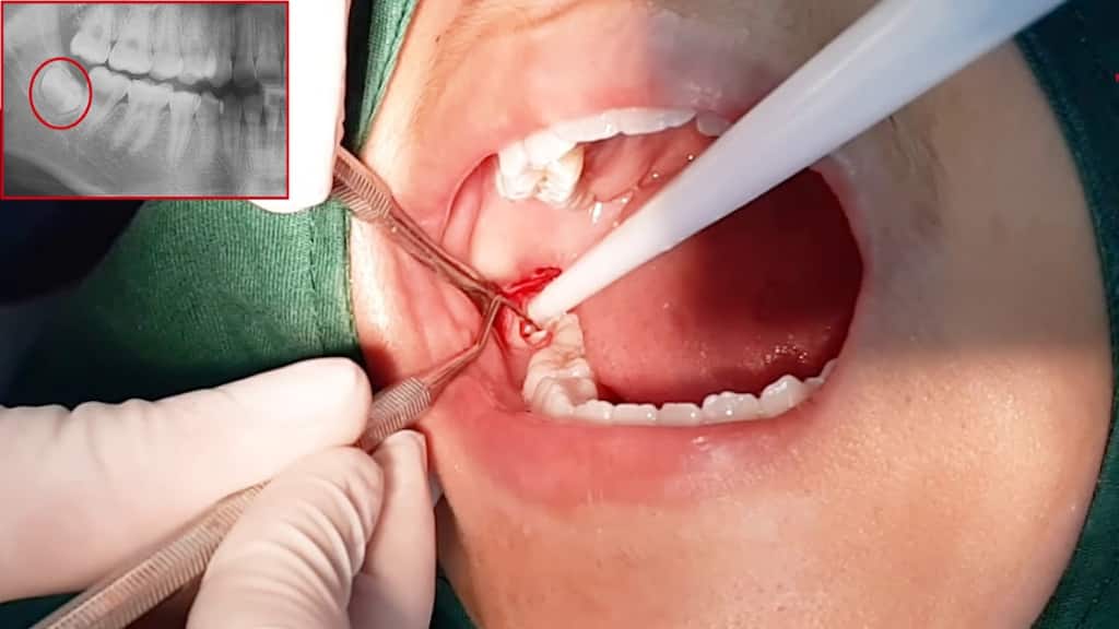 Nhổ răng khôn như thế nào?