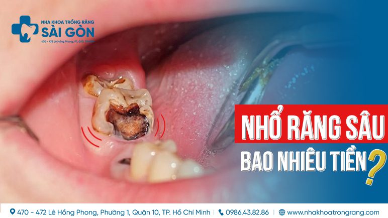 Nhổ răng sâu trong cung hàm dưới bao nhiêu tiền? Gallery 2