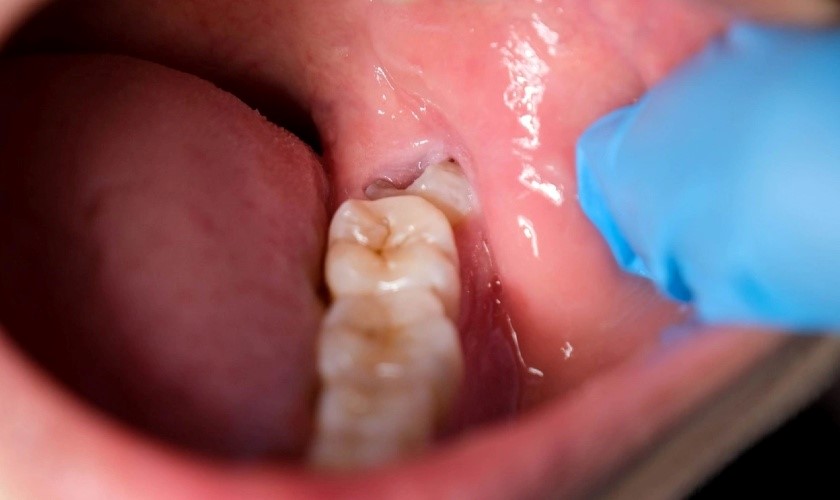 Nhổ Răng Số 8 Hàm Dưới