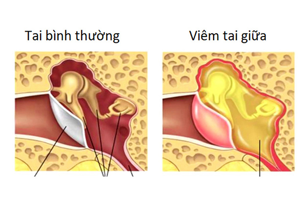 Nhức Lỗ Tai Phải Làm Sao?