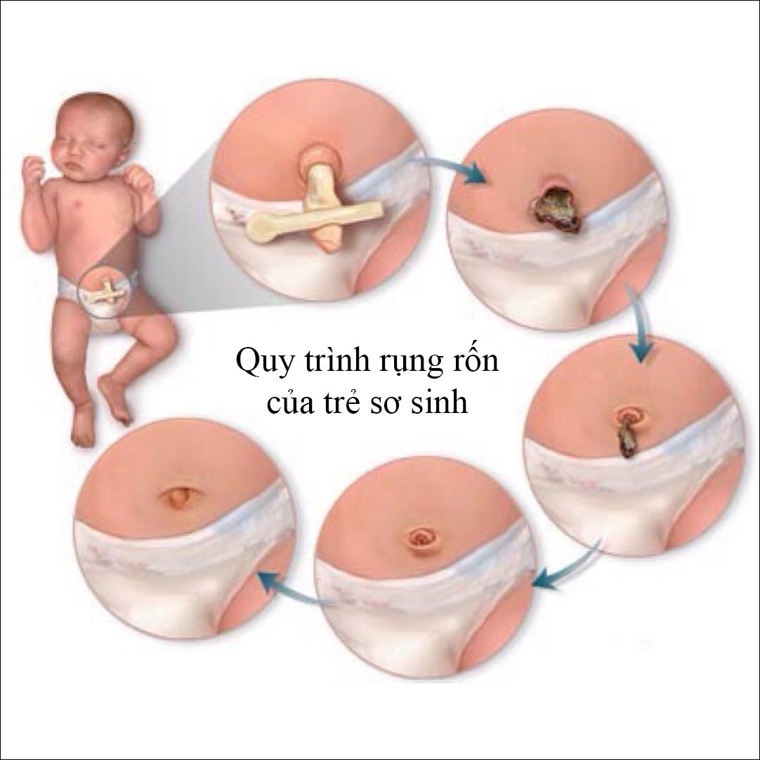 Cách vệ sinh rốn sau khi rụng Gallery 1