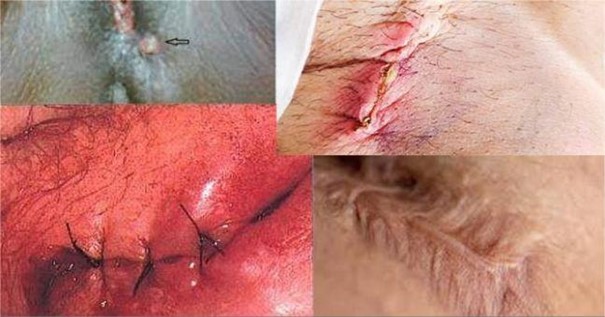 Vết Khâu Tầng Sinh Môn Bị Rách Phải Làm Sao? Gallery 1