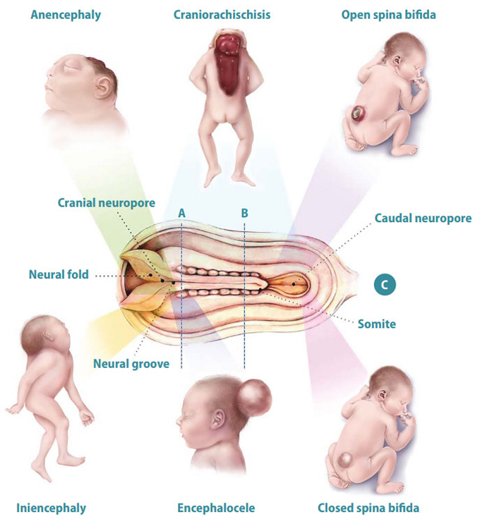 Những Dị Tật Bẩm Sinh Thường Gặp