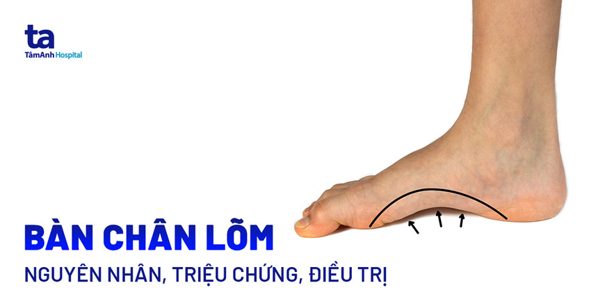 Tại Sao Bàn Chân Lõm Lại Khổ? Gallery 2