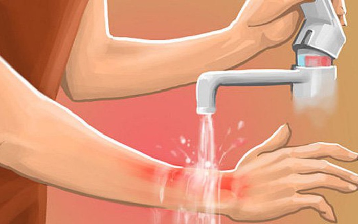Bị phỏng nên bôi gì? Gallery 2