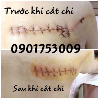 Cắt chỉ xong có được tắm không? Gallery 2