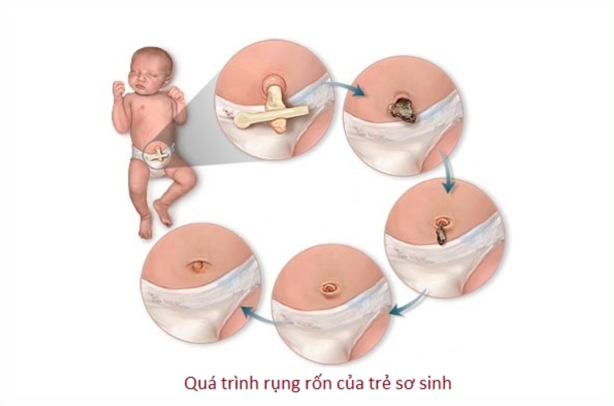 Cách vệ sinh rốn sau khi rụng Gallery 2