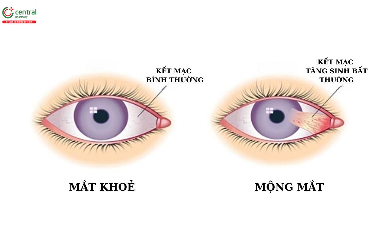 Bóc mộng mắt có nguy hiểm không? Gallery 1
