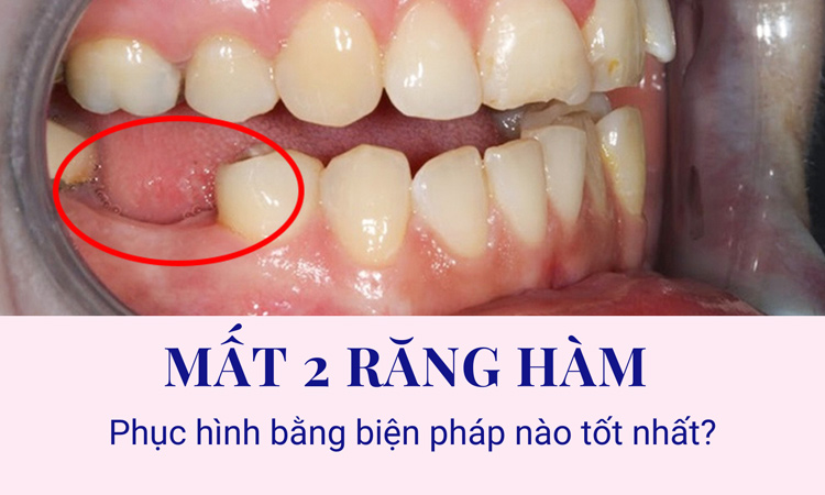 Nhổ 2 răng hàm cùng lúc: Điều cần biết Gallery 2