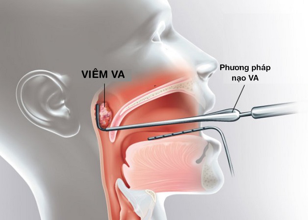 Có Nên Nạo Vét Cho Trẻ? Gallery 1