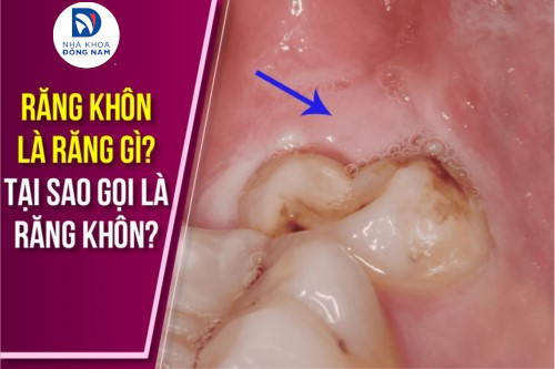 Tại Sao Lại Gọi Là Răng Khôn? Gallery 2