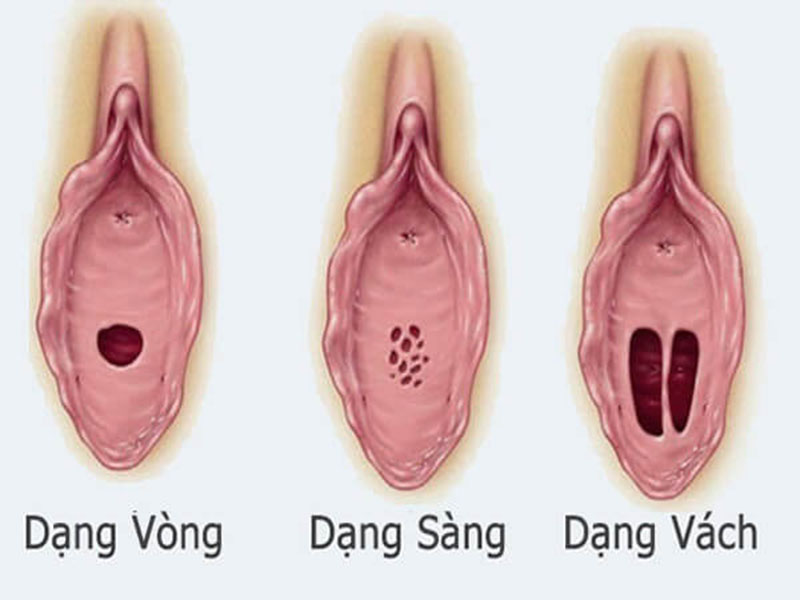 Màng trinh có dễ rách không? Gallery 1