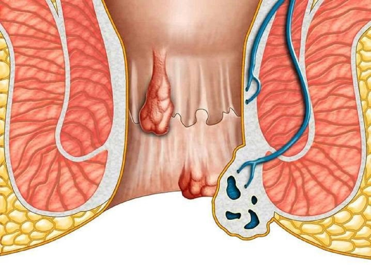 Bị trĩ có đi nghĩa vụ quân sự không? Gallery 2