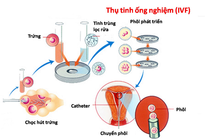 Quá Trình Thụ Tinh Ống Nghiệm (IVF) Gallery 2