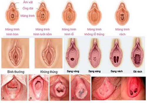 Làm sao biết đã rách màng trinh? Gallery 2